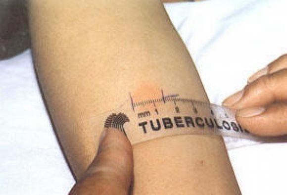 Salerno, studente affetto da tubercolosi: profilassi a scuola