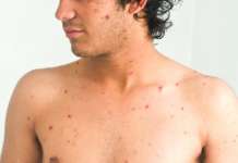 In forte aumento i casi di morbillo: in Campania copertura vaccinale insufficiente Morbillo