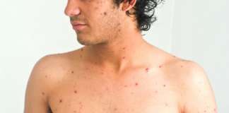 In forte aumento i casi di morbillo: in Campania copertura vaccinale insufficiente Morbillo