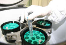 Scoperto il gene legato al più aggressivo tumore dei bambini