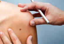 Melanoma: in Campania 1.500 casi l’anno, oltre 150 i decessi