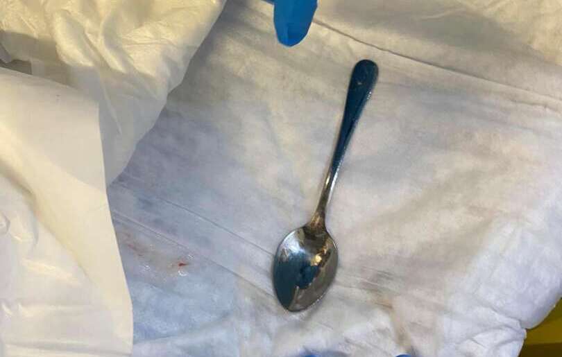 Ospedale Ruggi, recuperato cucchiaino nello stomaco di un paziente