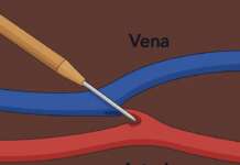 Dialisi più semplice e meno dolorosa: al Moscati tecnica mini-invasiva