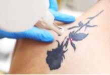 Dove il tatuaggio fa più male da rimuovere con il laser
