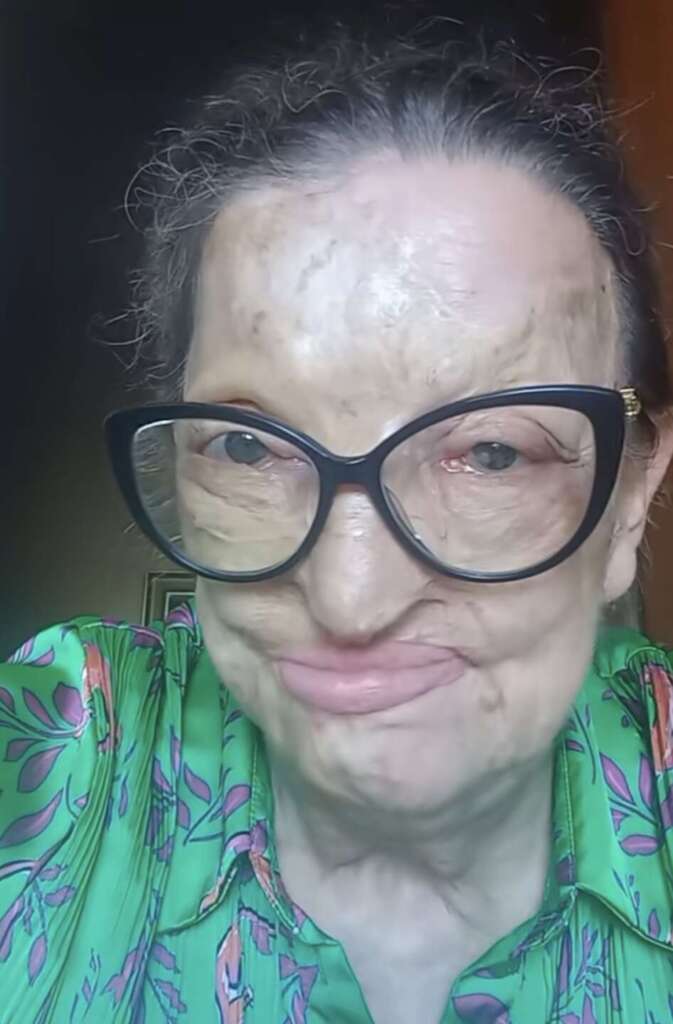 Filomena Lamberti, sfigurata dal marito nel 2012